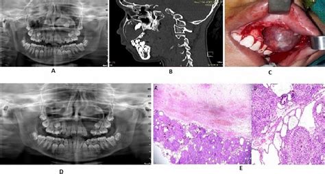 Adenomatoid Odontogenic Tumor