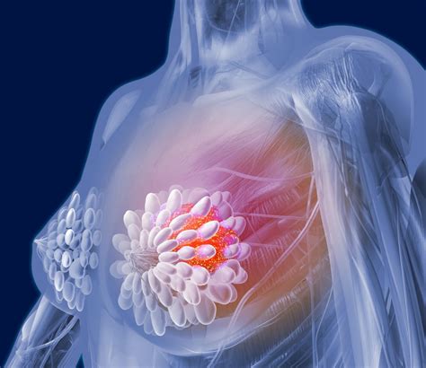 ribociclib prolongs progression free survival in premenopausal breast cancer clinical advisor