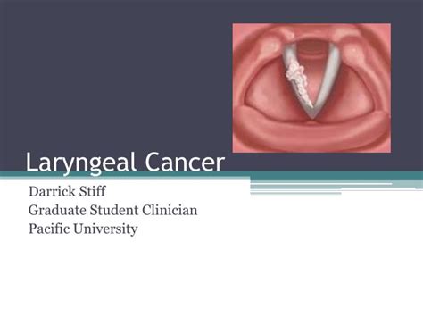 What Are Symptoms Of Larynx Cancer Laryngeal Cancer Symptoms Types