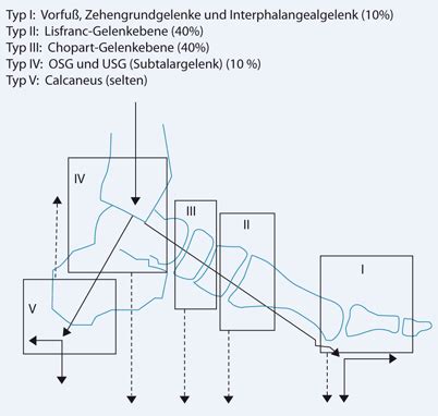 Als fuß bezeichnet man die am distalen ende der unteren extremität befindliche, aus knochen und muskulatur bestehende bewegliche einheit der primaten, die zum laufen und gegebenenfalls zum tasten und greifen befähigt. Epidemiologie und Klassifikation des diabetischen ...