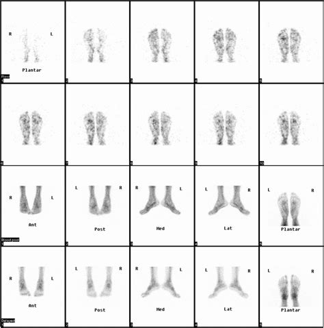Optimal Imaging Positions For 3 Phase Bone Scanning Of Patients With
