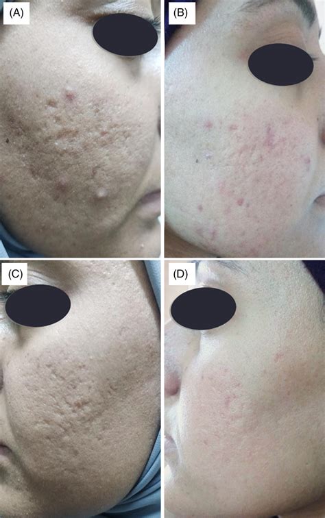 A 23‐year‐old Female Presented With Sever Post‐acne Scars Grade 4