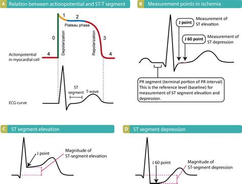 Figure 1 A The Relation Between The Action Potential And The Ecg