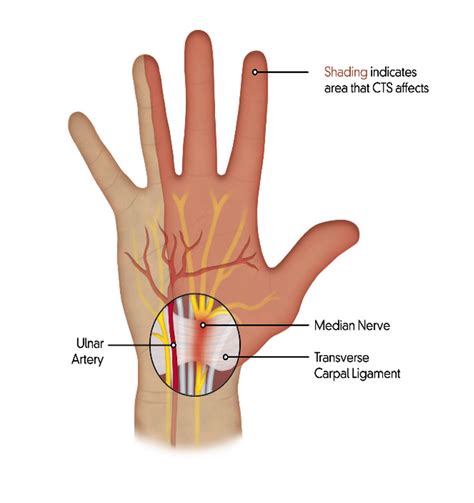 Boston Sports Carpal Tunnel Syndrome