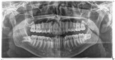 Wisdom Teeth And Oral Surgery In Powell Ohio Bright Smile Dental