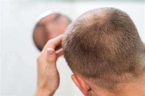 Why Do Men Go Bald And How To Prevent It