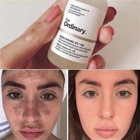 The Ordinary Alpha Arbutin Skincarisma Status Seri