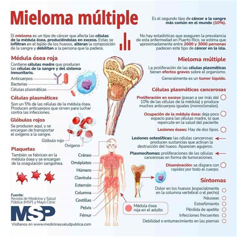 Mieloma Múltiple Infografía