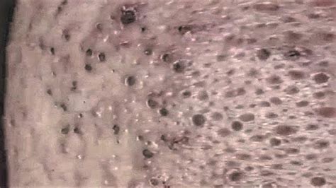 Oddly Satisfying Blackhead Extraction Video Youtube