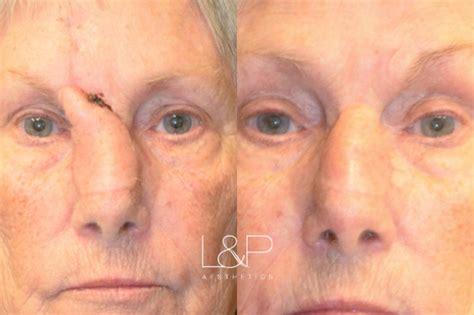 Reconstructive Surgery Before And After Photos Case 46 Palo Alto