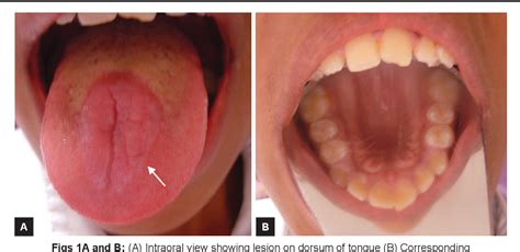 Suctional Hyperplasia Of Tongue As A Consequence Of Tongue Sucking Habit Semantic Scholar