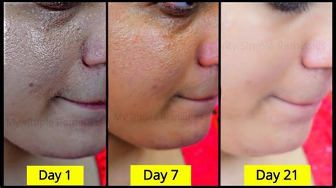 How To Brighten Skin Remove Acne Scars Dark Spots Discoloration