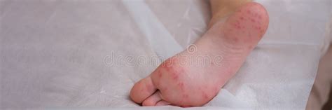 Child Foot With Flaky Skin After Burn Or Coxsackie Virus Closeup Stock