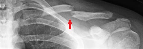 Clavicle Collarbone Fractures Childrens Mercy Kansas City