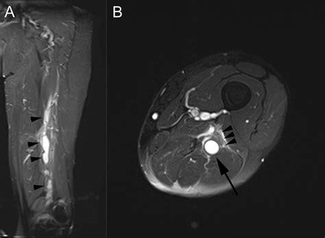 Teaching Neuroimages Intraneural Ganglion Cyst Of The Tibial Nerve