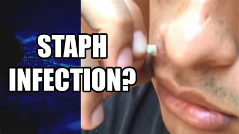 Face Cyst Staph Infected Cyst Extraction What Is It Largest Infected