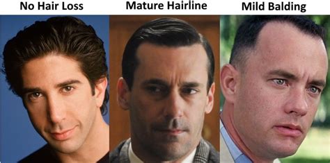This form of hair loss is often experienced by men and is commonly referred to as male pattern hair loss. The Mature Hairline Explained - Are You Balding or Maturing?