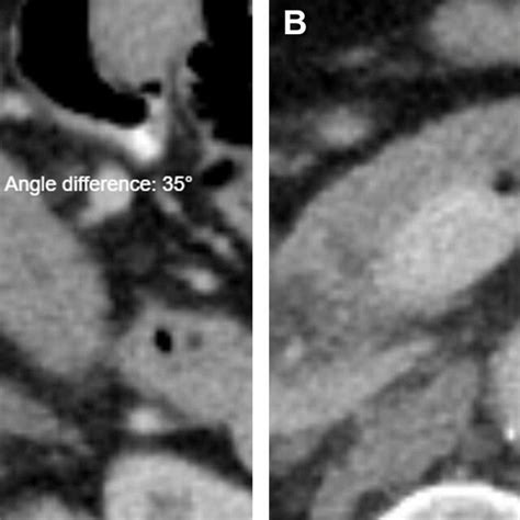 A Axial Ct Scan With Intravenous Contrast In The Portal Venous Phase Of