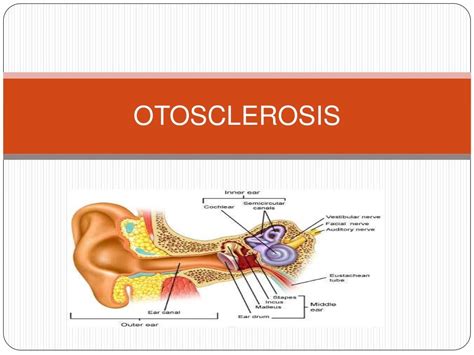 Otosclerosis