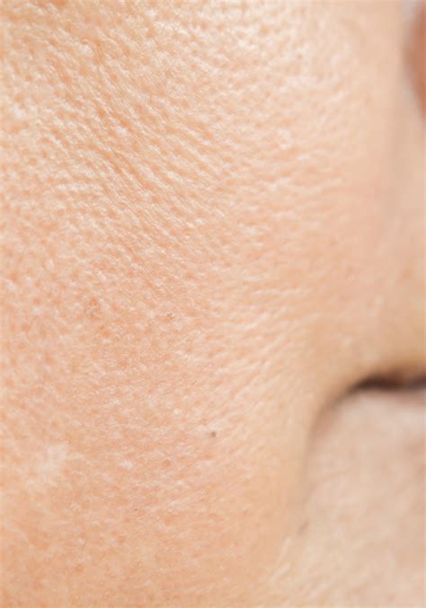 Enlarged Pores Treatment The Laser And Skin Clinic