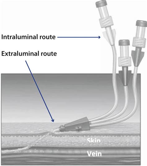 Prevention Of Central Venous Catheter Related Infection In The