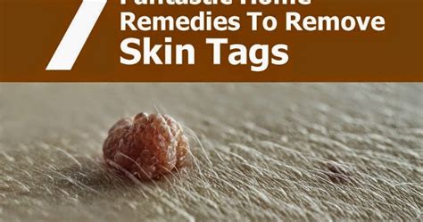 7 fantastic home remedies to remove skin tags handy diy