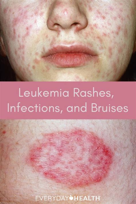 Leukemia Rash Pictures Signs And Symptoms Stem Cell Therapy
