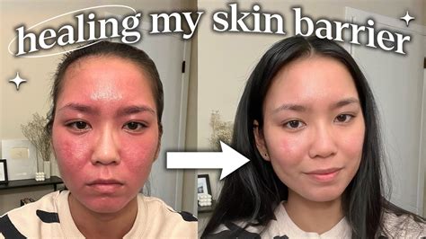 How I Repaired My Skin Barrier Not Sponsored Youtube