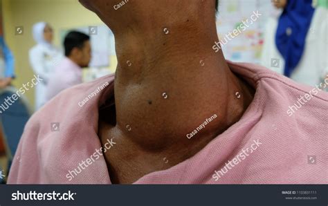 Huge Anterior Neck Swelling Left Thyroid Foto Stok 1103831111