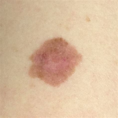 Images Of Skin Cancer Moles On Arms Cancerwalls