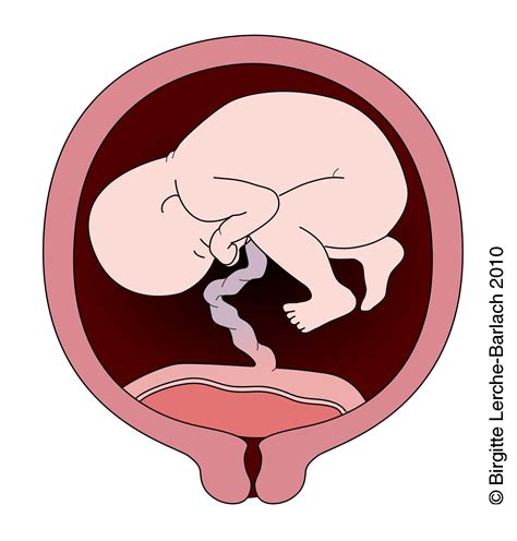 Placenta praevia and placental abruption are the most important causes of antepartum haemorrhage, being responsible for more than half of the cases1. Placenta praevia totalis og marginal - Lægehåndbogen på ...