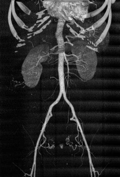 Normal Ct Renal Angiogram Image