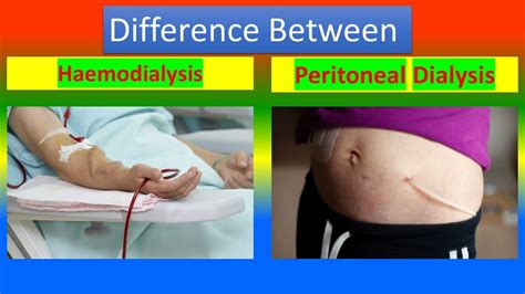 Difference Between Hemodialysis And Peritoneal Dialysis Youtube