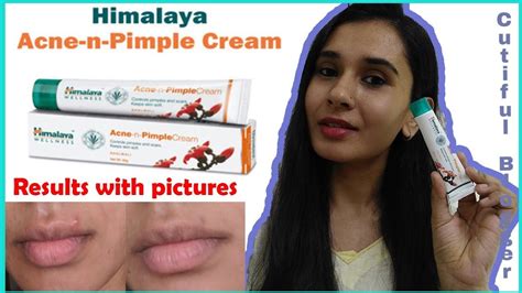 himalaya acne n pimple cream review how to get rid of acne acne treatment cutifulblogger