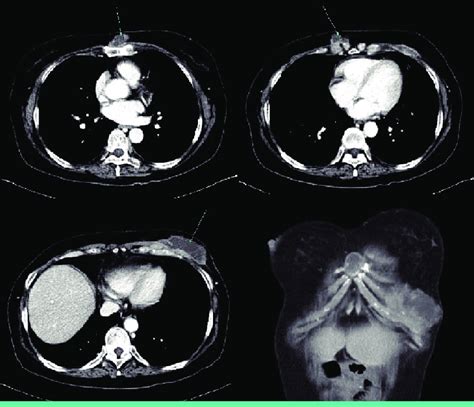 Initial Contrast Enhanced Ct Scan Shows Multiple Subcutaneous Abscesses