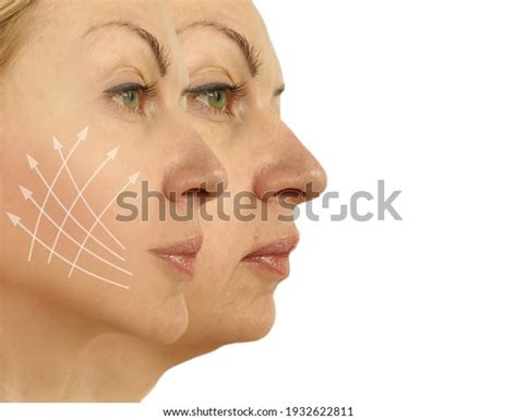 Woman Double Chin Before After Treatment Stock Photo 1932622811