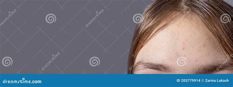 Acne On The Forehead Of A Teenage Girl Skin Problems In Children