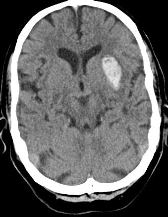 Axial non contrast ct image demonstrates a hyperdense focus centered on the globus pallidus on the left with a faint rim of low attenuation. Neurovascular Medicine