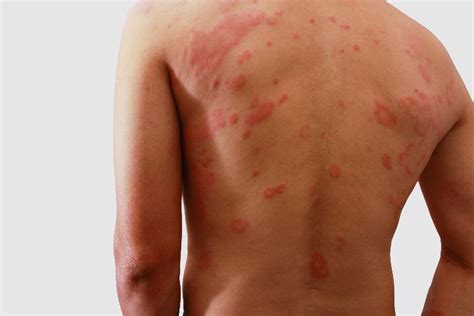 Causes Symptoms Treatment And Prevention Of Eczema
