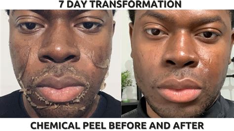 Chemical Peel On Black Skin Full Process Before And After