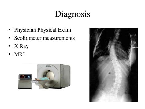 Orthotic Management Of Scoliosis