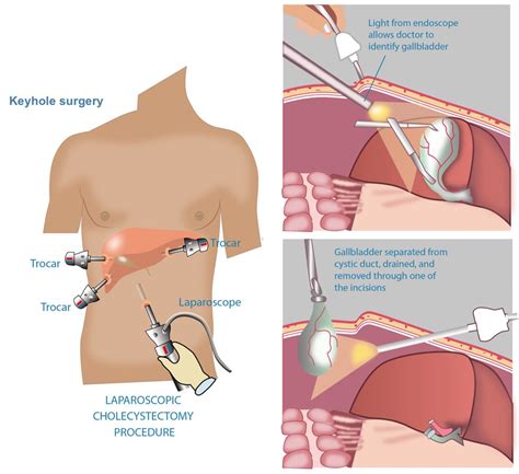 Gallbladder Procedures General And Hepato Pancreato Biliary Surgeon