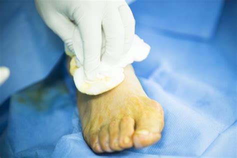 Ankle Sprain Ligament Tear Podiatrist Moore Foot And Ankle Specialists