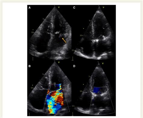 Transthoracic Echocardiogram Following The Combined Ablation Procedure