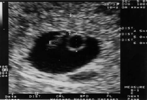 Pregnancy At 7 Weeks The Arrows Show The Site Of The Embryonic Stalk