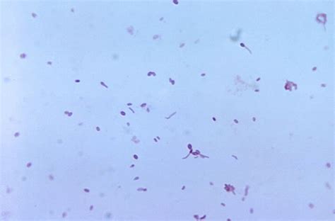 Some symptoms include blisters, tachycardia, swelling, and jaundice. Free picture: gram, positive, clostridium tertium ...