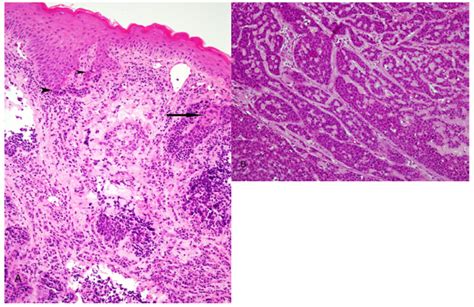 Basaloid Squamous Cell Carcinoma A Illustrates Biphasic