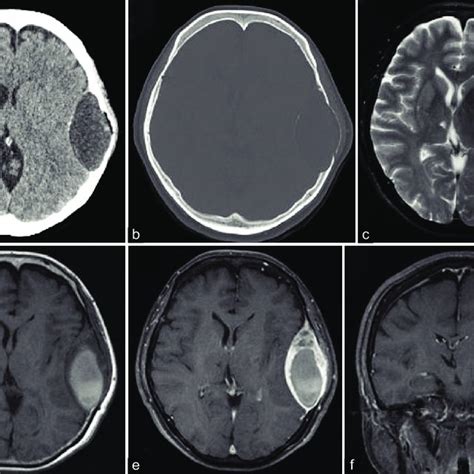 Axial Brain Ct Scans Showing The Hypodense Mass With Partially