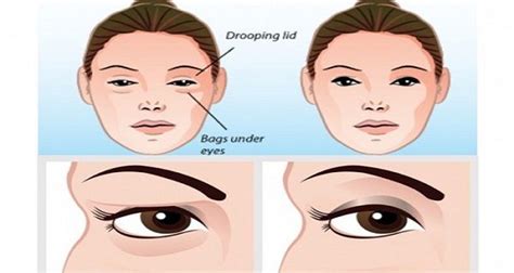 Solve Your Problem With Sagging Eyelids Naturally The Results Are