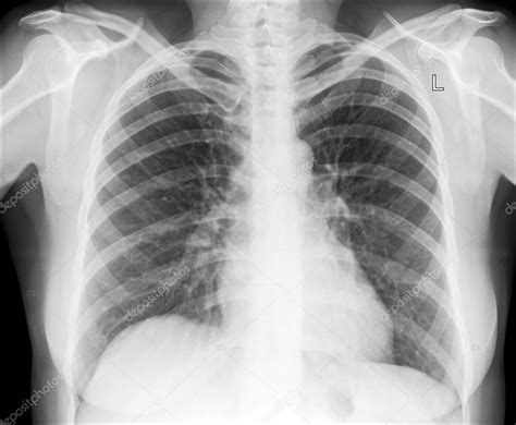 X Ray Image Of Human Chest For A Medical Diagnosis Stock Photo By